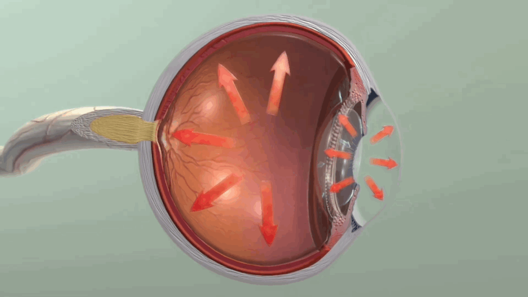 intraocular pressure