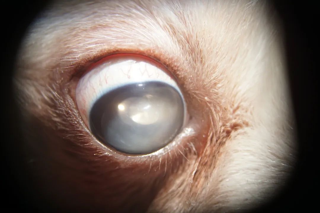 OD Lens dislocation into anterior chamber