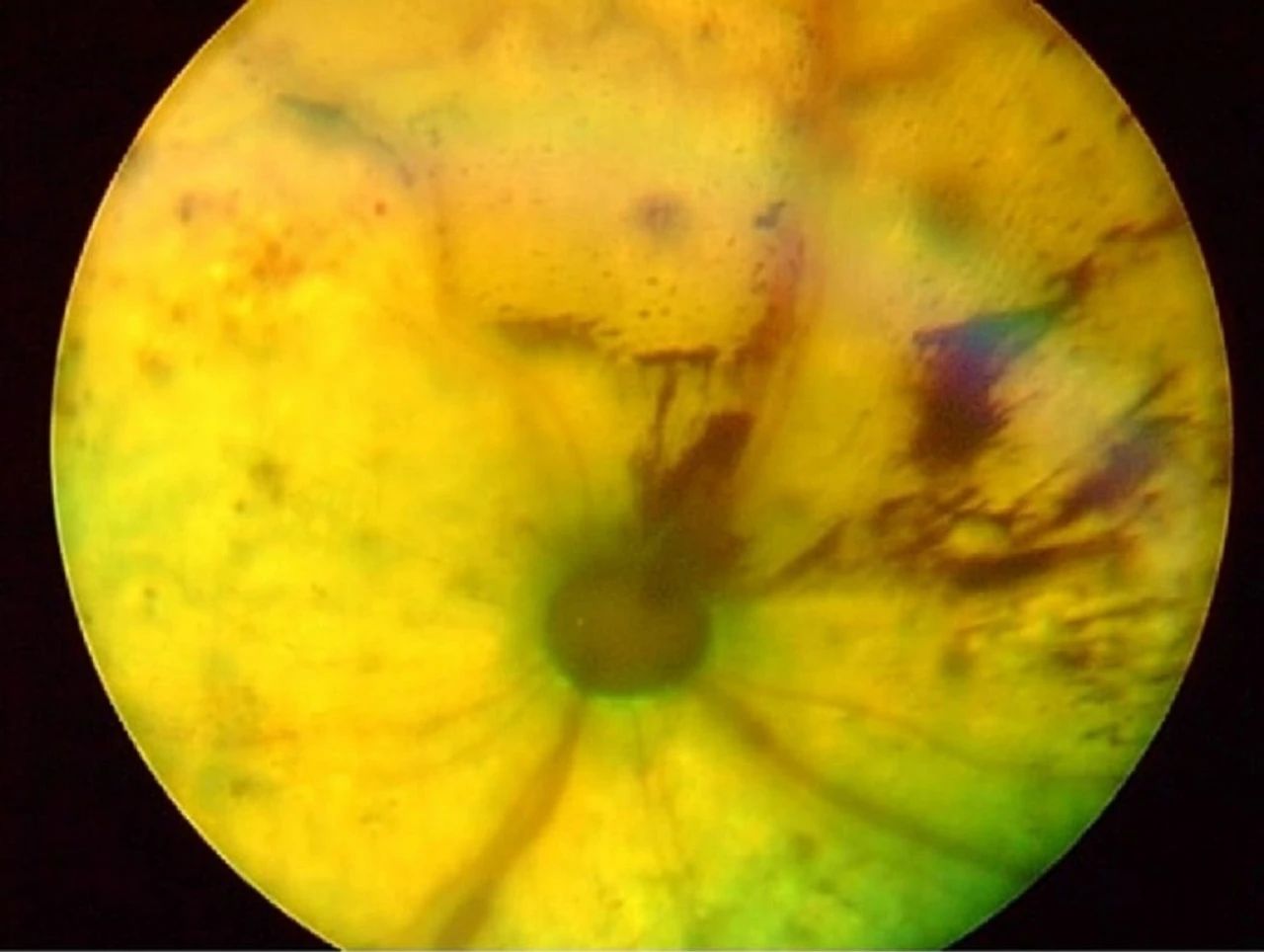 Cat eye systemic hypertension